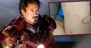 Iron Man antics China blast victim tries to remove metal