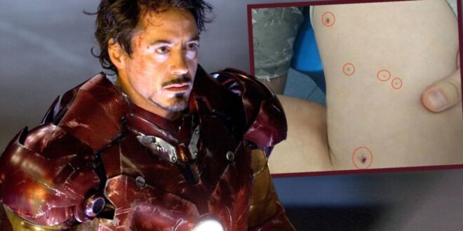 Iron Man antics China blast victim tries to remove metal