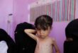 Malnutrition worsening in Yemens government controlled areas UN says