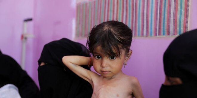 Malnutrition worsening in Yemens government controlled areas UN says